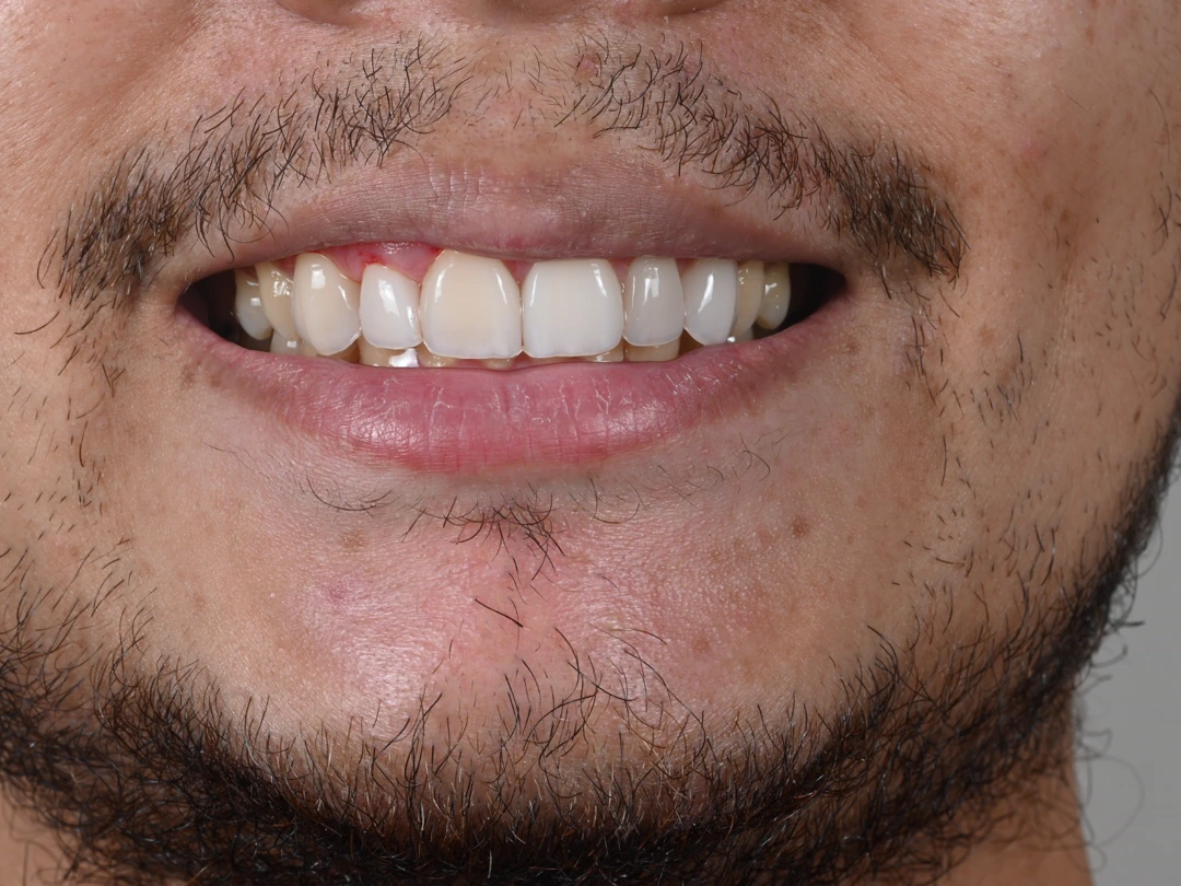 La sonrisa del paciente terminada, con los dientes anteriores reconstruidos